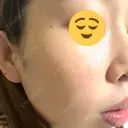 光治療（フォトフェイシャルなど） / ピーリング（ハリ・ツヤ） 東京美容クリニック 表参道本院 DAY 5 サムネイル用