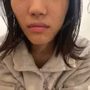 ボトックス（エラ・小顔） ルラ美容クリニック 千葉院 / ルラスキンクリニック 千葉院 DAY 0 サムネイル用