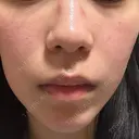 ルメッカ ルラ美容クリニック 札幌本院 DAY 2 サムネイル用