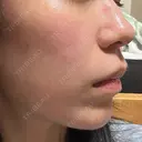 ルメッカ ルラ美容クリニック 札幌本院 DAY 2 サムネイル用