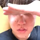 ほくろ・いぼ除去レーザー（肌） 共立美容外科 福岡院 AFTER サムネイル用