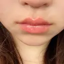 ヒアルロン酸注入（唇） 目白ホワイトクリニック DAY 0 サムネイル用