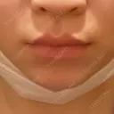 ヒアルロン酸注入（唇） 目白ホワイトクリニック AFTER サムネイル用