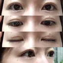 眼瞼下垂（切開） / 上まぶたの脂肪取り 白山クリニック 大分 DAY 34 サムネイル用