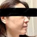 ルメッカ 東京シルククリニック 東京神田院 DAY 9 サムネイル用