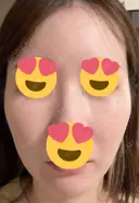 ピーリング（ハリ・ツヤ） / ピコスポット ビューティー和心クリニック 浅草院 DAY 2 サムネイル用