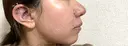 鼻尖形成（切開） / 小鼻縮小（切開） / 軟骨移植 ASTRA BEAUTY CLINIC DAY 6 サムネイル用