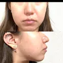 鼻尖形成（切開） / 小鼻縮小（切開） / 軟骨移植 ASTRA BEAUTY CLINIC DAY 64 サムネイル用