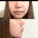 鼻尖形成（切開） / 小鼻縮小（切開） / 軟骨移植 ASTRA BEAUTY CLINIC AFTER サムネイル用