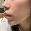 ルメッカ ルラ美容クリニック 札幌本院 DAY 4 サムネイル用