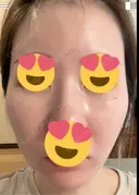 ピーリング（ハリ・ツヤ） / ピコスポット ビューティー和心クリニック 浅草院 DAY 3 サムネイル用