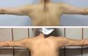 脂肪吸引（二の腕） ヨンセスリムライン DAY 5 サムネイル用