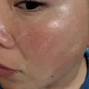 ルメッカ 大美会クリニック 京都烏丸院 DAY 6 サムネイル用