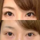 二重切開 / 眼瞼下垂（切開） / 上まぶたたるみ取り 湘南美容クリニック 新宿南口院 DAY 422 サムネイル用