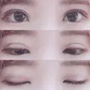 二重埋没 湘南美容クリニック 長野院 DAY 15 サムネイル用