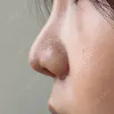 鼻尖形成（切開） / 小鼻縮小（切開） / 軟骨移植 / 眉間プロテーゼ / 鼻柱下降・鼻唇角形成（猫手術） グローバルビューティークリニック 大阪院 DAY 46 サムネイル用