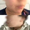 ハイフ（顔） 表参道メディカルクリニック 名古屋院 AFTER サムネイル用