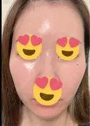 ピーリング（ハリ・ツヤ） / ピコスポット ビューティー和心クリニック 浅草院 DAY 4 サムネイル用