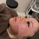 リジュラン 心斎橋KT美容クリニック AFTER サムネイル用