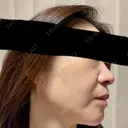 ルメッカ 東京シルククリニック 東京神田院 DAY 12 サムネイル用