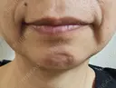 脂肪吸引（顔） 湘南美容クリニック 松戸院 DAY 31 サムネイル用