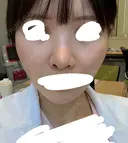 鼻中隔延長（切開） / その他（鼻） / 軟骨移植 / 鼻孔縁下降 / 鼻柱下降・鼻唇角形成（猫手術） KIHARU CLINIC DAY 15 サムネイル用