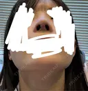 鼻中隔延長（切開） / その他（鼻） / 軟骨移植 / 鼻孔縁下降 / 鼻柱下降・鼻唇角形成（猫手術） KIHARU CLINIC DAY 15 サムネイル用
