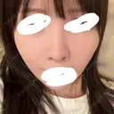 鼻中隔延長（切開） / その他（鼻） / 軟骨移植 / 鼻孔縁下降 / 鼻柱下降・鼻唇角形成（猫手術） KIHARU CLINIC DAY 15 サムネイル用