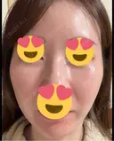 ピーリング（ハリ・ツヤ） / ピコスポット ビューティー和心クリニック 浅草院 DAY 6 サムネイル用