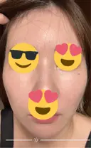 ピーリング（ハリ・ツヤ） / ピコスポット ビューティー和心クリニック 浅草院 DAY 7 サムネイル用