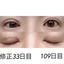 二重埋没 / 目元修正 湘南美容クリニック 広島院 DAY 33 サムネイル用