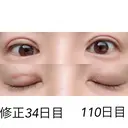二重埋没 / 目元修正 湘南美容クリニック 広島院 DAY 34 サムネイル用