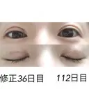 二重埋没 / 目元修正 湘南美容クリニック 広島院 DAY 36 サムネイル用