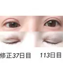 二重埋没 / 目元修正 湘南美容クリニック 広島院 DAY 37 サムネイル用