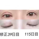 二重埋没 / 目元修正 湘南美容クリニック 広島院 AFTER サムネイル用
