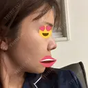 鼻尖形成（切開） / 小鼻縮小（切開） / 軟骨移植 / 眉間プロテーゼ / 鼻柱下降・鼻唇角形成（猫手術） グローバルビューティークリニック 大阪院 DAY 55 サムネイル用