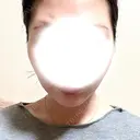 糸リフト / バッカルファット除去 / 脂肪吸引（顔） / ジョールファット除去 / ボトックス（あご） / ボトックス（エラ・小顔） アリエル美容クリニック 大宮院 DAY 131 サムネイル用