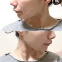 糸リフト / バッカルファット除去 / 脂肪吸引（顔） / ジョールファット除去 / ボトックス（あご） / ボトックス（エラ・小顔） アリエル美容クリニック 大宮院 DAY 131 サムネイル用