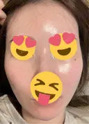 ピーリング（ハリ・ツヤ） / ピコスポット ビューティー和心クリニック 浅草院 DAY 8 サムネイル用