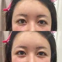 肌ヒアルロン酸注入（たるみ・シワ改善） しのぶ皮膚科 AFTER サムネイル用