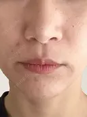 人中短縮 / 小鼻縮小（非切開） 湘南美容クリニック 仙台院 DAY 113 サムネイル用