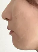 人中短縮 / 小鼻縮小（非切開） 湘南美容クリニック 仙台院 DAY 113 サムネイル用