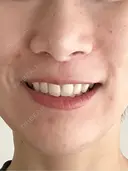 人中短縮 / 小鼻縮小（非切開） 湘南美容クリニック 仙台院 DAY 113 サムネイル用