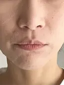 人中短縮 / 小鼻縮小（非切開） 湘南美容クリニック 仙台院 AFTER サムネイル用