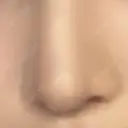 鼻尖形成（切開） / 小鼻縮小（切開） / 軟骨移植 / 鼻柱下降・鼻唇角形成（猫手術） / ボトックス（エラ・小顔） ASTRA BEAUTY CLINIC DAY 69 サムネイル用