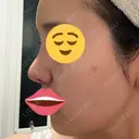 鼻尖形成（切開） / 小鼻縮小（切開） / 軟骨移植 / 眉間プロテーゼ / 鼻柱下降・鼻唇角形成（猫手術） グローバルビューティークリニック 大阪院 DAY 58 サムネイル用