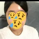 骨切り（あご） / 骨削り（エラ） / 骨削り（頬） リッツ美容外科 東京院 DAY 28 サムネイル用