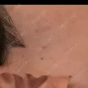 医療脱毛（顔） エスクリニック 恵比寿 DAY 31 サムネイル用