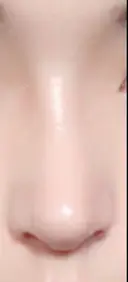 隆鼻術 / 鼻尖形成（切開） / 鼻中隔延長（切開） / 鼻尖縮小 FROM B整形外科 (旧バウム整形外科) DAY 18 サムネイル用