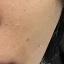 ピコレーザートーニング（美白・肝斑） / ピコフラクショナルレーザー（毛穴・ニキビ跡） おおかみ美容のクリニック 新宿院 AFTER サムネイル用